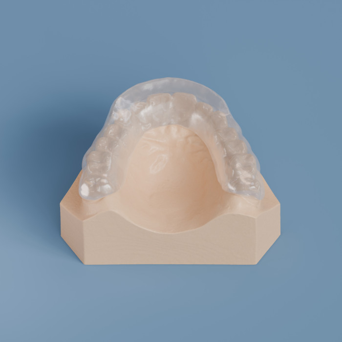 Full Contact Splint with Anterior Guidance - Spear Style :: Great