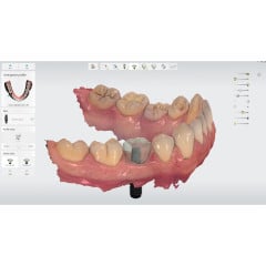 3Shape Implant Studio