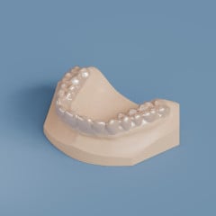 Invisible Retainer - Full Occlusal Coverage