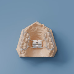 Bonded Rapid Palatal Expander