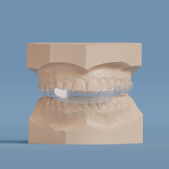 Full Contact Splint with Anterior Guidance - Spear Style