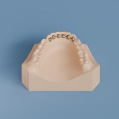 Krause Retainer - 6 Pads (No Matrix)