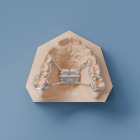Rapid Palatal Expander - Sintered